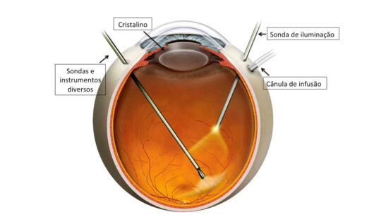 cirurgia de vitrectomia